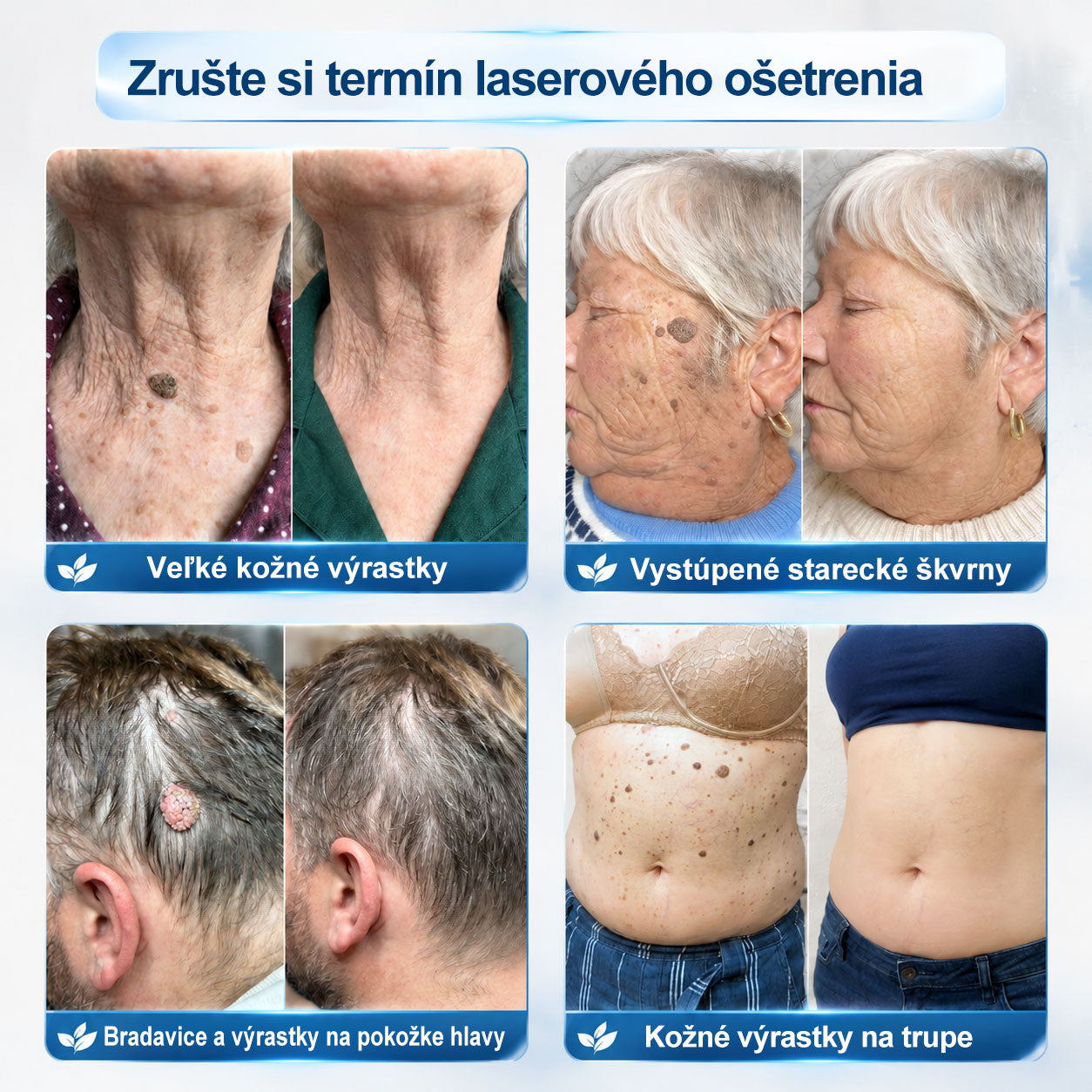 𝐎𝐟𝐢𝐜𝐢𝐚𝐥𝐧𝐲 𝐨𝐛𝐜𝐡𝐨𝐝 𝐦𝐚𝐫𝐤𝐲 | ✅️👩‍⚕️𝐏i𝐜𝐝o® 7dni Prípravok na odstránenie kožných výrastkov a pigmentových škvŕn (bezbolestný roll-on aplikátor bez jaziev) ❤️