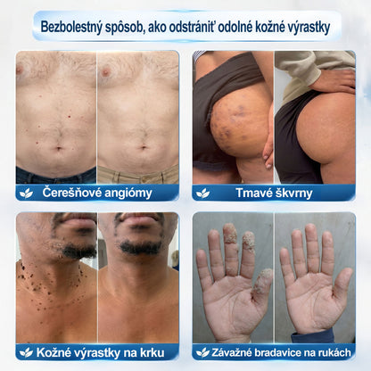 𝐎𝐟𝐢𝐜𝐢𝐚𝐥𝐧𝐲 𝐨𝐛𝐜𝐡𝐨𝐝 𝐦𝐚𝐫𝐤𝐲 | ✅️👩‍⚕️𝐏i𝐜𝐝o® 7dni Prípravok na odstránenie kožných výrastkov a pigmentových škvŕn (bezbolestný roll-on aplikátor bez jaziev) ❤️