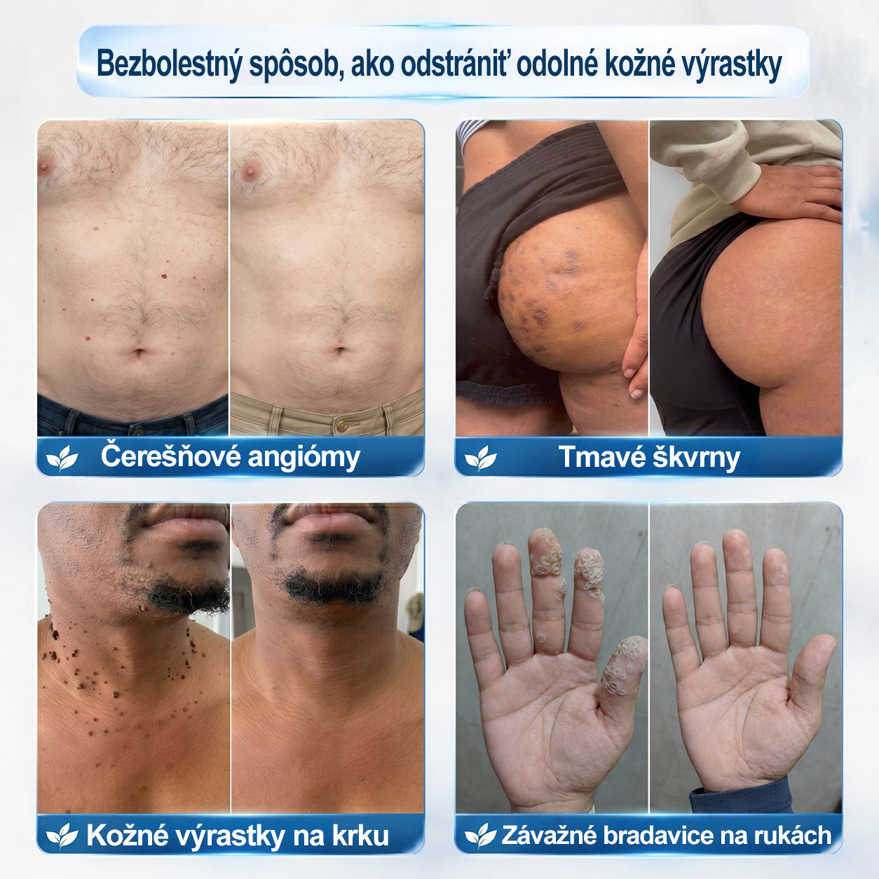 𝐎𝐟𝐢𝐜𝐢𝐚𝐥𝐧𝐲 𝐨𝐛𝐜𝐡𝐨𝐝 𝐦𝐚𝐫𝐤𝐲 | ✅️👩‍⚕️𝐏i𝐜𝐝o® 7dni Prípravok na odstránenie kožných výrastkov a pigmentových škvŕn (bezbolestný roll-on aplikátor bez jaziev) 🌺