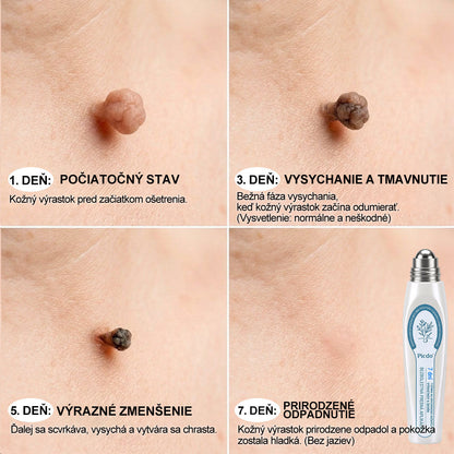 𝐎𝐟𝐢𝐜𝐢𝐚𝐥𝐧𝐲 𝐨𝐛𝐜𝐡𝐨𝐝 𝐦𝐚𝐫𝐤𝐲 | ✅️👩‍⚕️𝐏i𝐜𝐝o® 7dni Prípravok na odstránenie kožných výrastkov a pigmentových škvŕn (bezbolestný roll-on aplikátor bez jaziev) 🌱